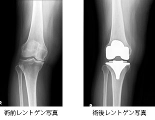 膝の痛みを完治させるために人工関節手術を考えているあなたへ