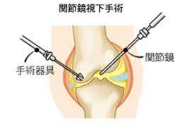 「半月板損傷の手術した膝が痛い」運動が再開できた